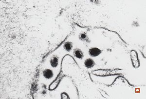 F,65y. | Epstein-Barr virus - hairy leukoplakia of tongue